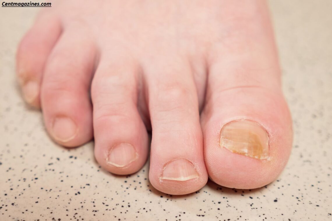 Why Are My Toenails Yellow? 9 Surprising Causes & Easy Fixes