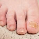 Why Are My Toenails Yellow? 9 Surprising Causes & Easy Fixes