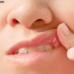 Why Is the Roof of My Mouth Sore? Causes & Fixes
