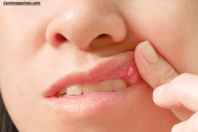 Why Is the Roof of My Mouth Sore? Causes & Fixes