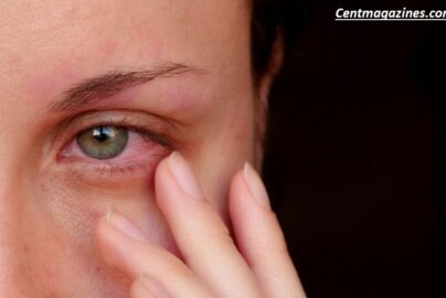 Why Are My Eyes Always Red? Causes, Treatments, and When to Worry