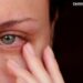 Why Are My Eyes Always Red? Causes, Treatments, and When to Worry