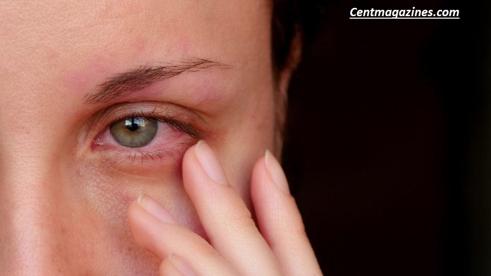 Why Are My Eyes Always Red? Causes, Treatments, and When to Worry