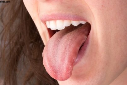 Why Does the Side of My Tongue Hurt? 7 Surprising Causes You Shouldn’t Ignore