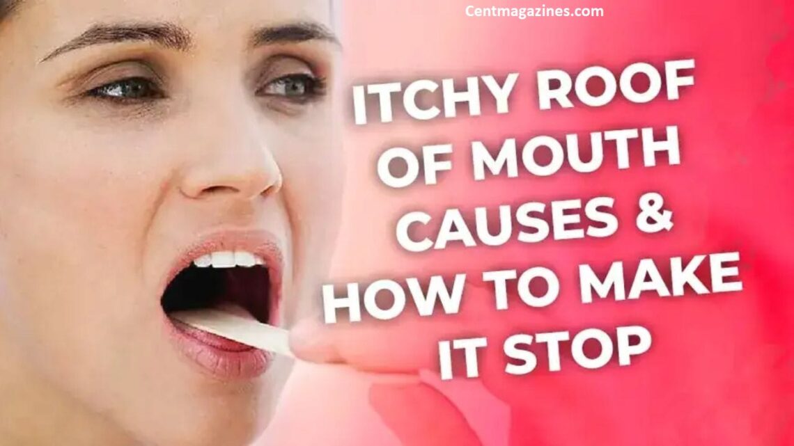 Why Is the Roof of My Mouth Itchy? Here's What's Actually Going On