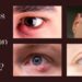 Why Do I Have a Bump on My Eyelid? (I've Had Three Here's What I Learned)