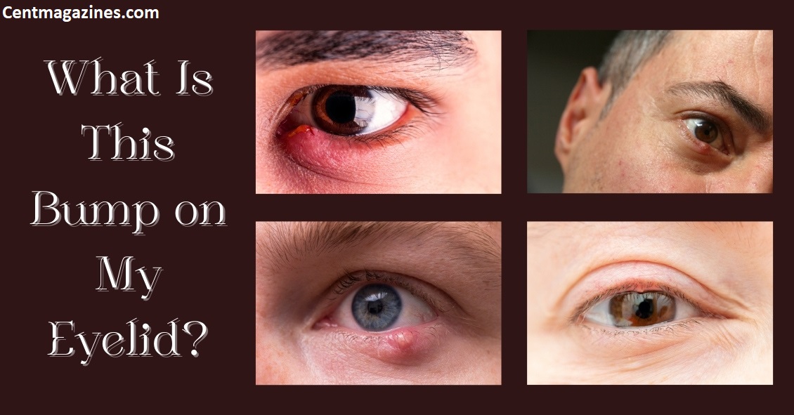 Why Do I Have a Bump on My Eyelid? (I've Had Three Here's What I Learned)