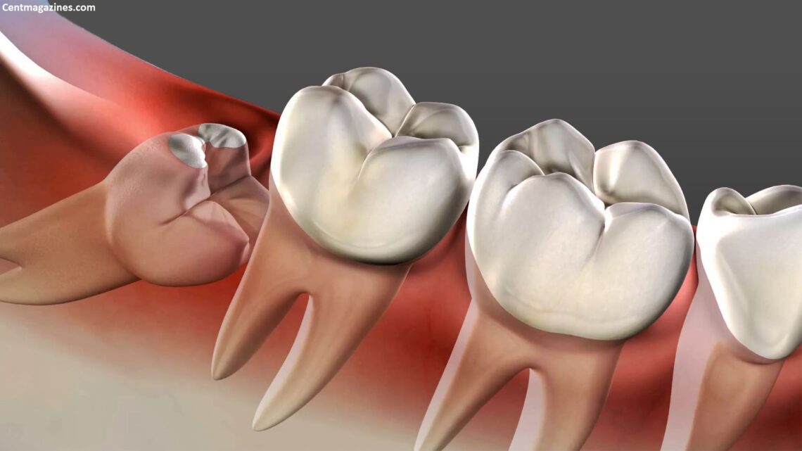 Why Does Wisdom Tooth Pain Come and Go? I Lived Through It Here's What's Actually Happening