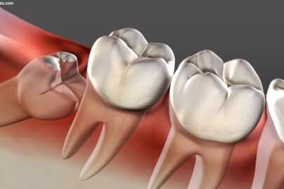 Why Does Wisdom Tooth Pain Come and Go? I Lived Through It Here's What's Actually Happening