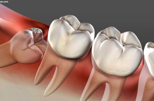Why Does Wisdom Tooth Pain Come and Go? I Lived Through It Here's What's Actually Happening