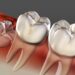 Why Does Wisdom Tooth Pain Come and Go? I Lived Through It Here's What's Actually Happening